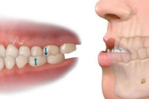 Quy Trình Niềng Răng Móm Chi Tiết: Từ A Đến Z