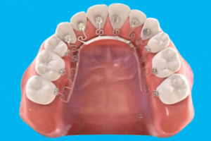 Niềng Răng Brava: Công Nghệ Mới và Những Lợi Ích Nổi Bật