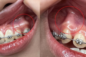 Niềng Răng Ở Tuổi 22: Điều Kiện Và Kết Quả Mong Đợi