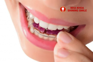 Niềng Răng Tháo Lắp Kim Loại Cho Người Lớn: Ưu Nhược Điểm Và Lựa Chọn