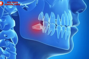 Thời gian niềng răng để đạt hiệu quả là bao lâu?