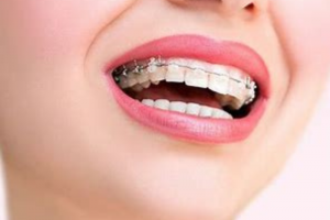 Dán Sứ Veneer: Giải Pháp Hoàn Hảo Cho Hàm Răng Đẹp Tự Nhiên