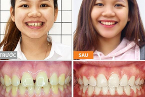 Trước và sau khi niềng răng: Sự khác biệt rõ rệt
