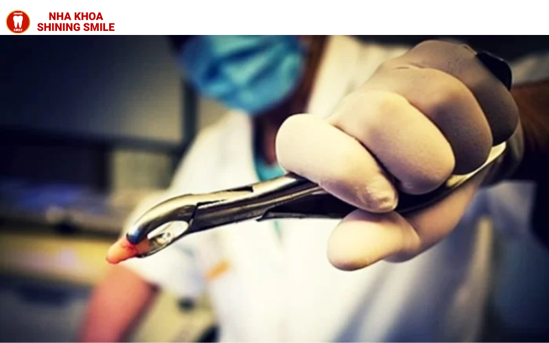 Những thắc mắc thường gặp về niềng răng hô