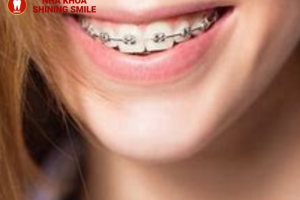 Thông tin từ A-Z mắc cài tự buộc