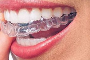 Răng Sứ Zirconia: Lợi Ích Và Chi Phí Thực Hiện