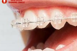 Niềng răng cho trẻ em cần lưu ý những gì?