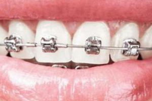 Chi phí niềng răng một hàm mới nhất 2024