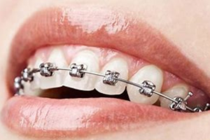 Niềng răng có đau không? Giảm đau khi niềng răng