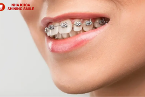 Niềng răng không mắc cài là gì? Ưu và nhược điểm của niềng răng không mắc cài