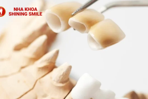 Trồng Răng Sứ Mất Bao Lâu Thời Gian? Tìm Hiểu Ngay!