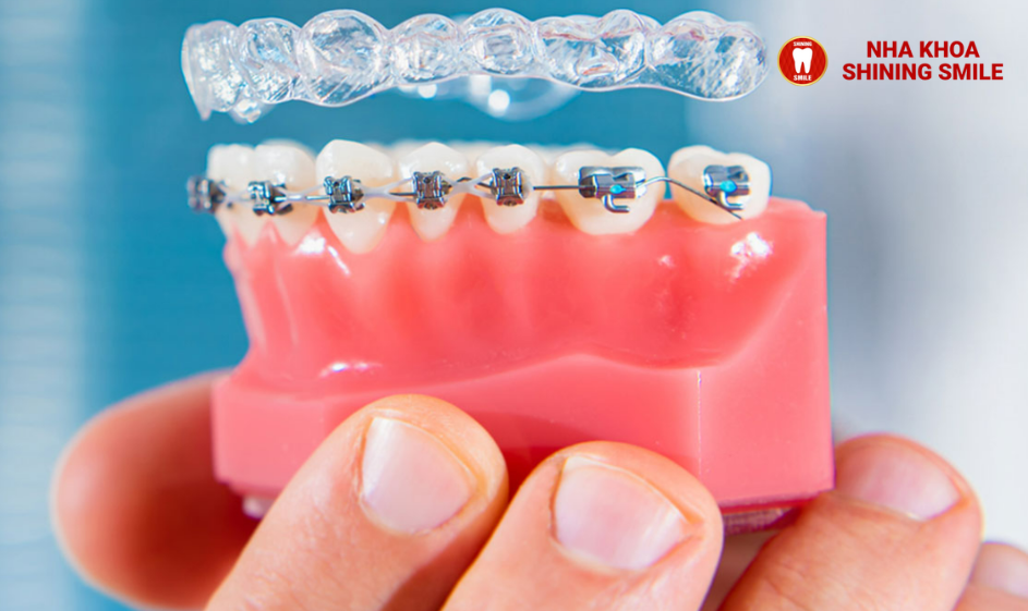 Mắc Cài Inox Tự Đóng: Lựa Chọn Hiệu Quả Cho Niềng Răng