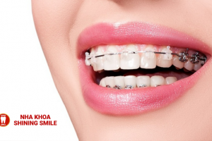 Tất Tần Tật Về Niềng Răng Cố Định: Lựa Chọn Nào Cho Bạn?