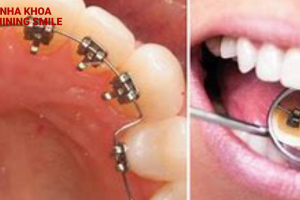 Niềng răng mặt trong: Tất tần tật chi phí từ A-Z