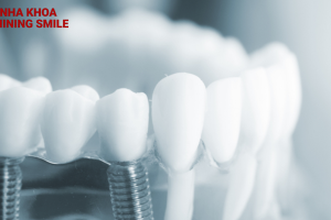 Giải đáp thắc mắc: Trồng răng giả có niềng được không?