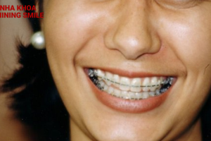 Tuổi 40 liệu có phù hợp để niềng răng