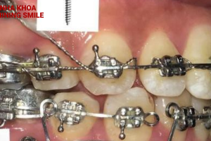 Những điều bạn cần biết về cắm vis niềng răng