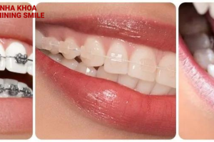 Tất tần tật về chi phí chỉnh lệch 1 răng