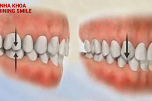 Năng khớp cắn trong niềng răng: Tác dụng thần kỳ mà bạn chưa biết