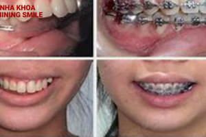 Niềng răng khớp cắn ngược: Những quy trình đằng sau sự hoàn hảo