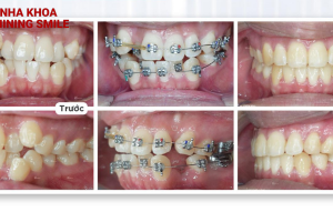 Thời gian chính xác cho câu hỏi niềng răng bao lâu thì răng bắt đầu dịch chuyển