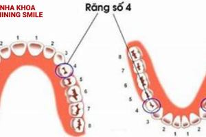 Có nên nhổ răng số 4 để niềng không?