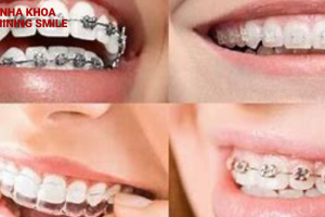 Những điều bạn nên biết về niềng răng khớp cắn sâu