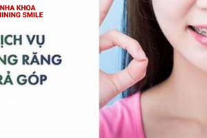 Niềng răng trả góp cho sinh viên: Mức giá niềng răng rẻ chưa từng có