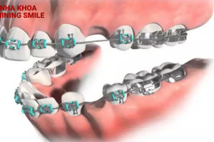 Niềng răng mắc cài kim loại: Bí quyết cho nụ cười rạng ngời cùng SHINING SMILE