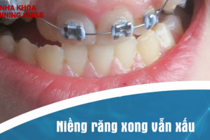 Niềng răng xong vẫn xấu: Nguyên nhân tiềm ẩn