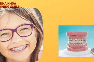 Những điều bạn cần biết về siết răng khi niềng