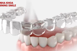 Đeo hàm duy trì vẫn bị chạy răng: Nguyên nhân và cách khắc phục