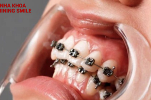 Nguyên nhân niềng răng xong bị hô