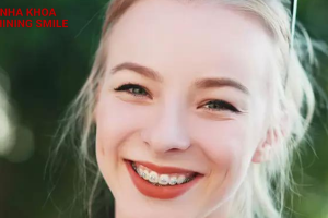 Niềng răng có giúp mũi cao hơn không? Những sự thay đổi trên khuôn mặt khi niềng