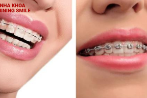 So sánh mắc cài sứ và kim loại