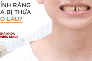 Giải Pháp Hiệu Quả Cho Răng Cửa Thưa Cùng SHINING SMILE
