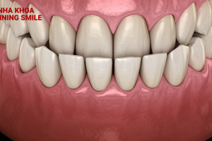 Chi Phí Niềng Răng Khớp Cắn Ngược Tại SHINING SMILE: Đầu Tư Cho Nụ Cười Hoàn Hảo