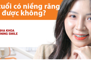25 Tuổi Niềng Răng – Giấc Mơ Nụ Cười Hoàn Hảo Cùng SHINING SMILE