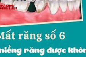 Mất Răng Số 6 Có Niềng Được Không? Giải Đáp Cùng SHINING SMILE