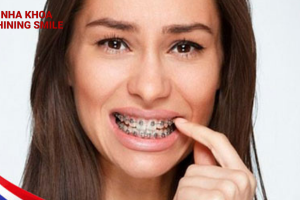 Giảm Đau Khi Niềng Răng: Bí Quyết Từ SHINING SMILE