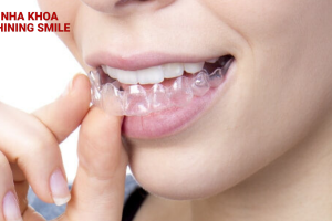 Niềng Răng Trong Suốt Mất Bao Lâu? Khám Phá Cùng SHINING SMILE