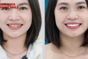 Bí Mật Giấu Kín về Giá Làm Khít Răng Thưa tại SHINING SMILE"