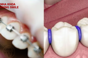 "Khám phá Niềng Răng - Bí Mật Cho Nụ Cười Tươi Sáng cùng SHINING SMILE