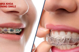 Làm Đẹp Nụ Cười Với Niềng Răng: Suốt hay Mắc Cài? SHINING SMILE Tư Vấn Chuyên Sâu!