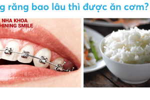 Niềng Răng - Bí Mật Ăn Cơm Sớm Đã Có Lời Giải Tại SHINING SMILE!