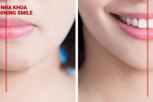 Niềng răng bị lệch mặt không còn đáng lo: Biến đổi nụ cười hoàn hảo với niềng răng Shining Smile!