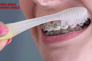 Bật mí bí quyết sở hữu nụ cười hoàn hảo với niềng răng không bị hở lợi - Đến với SHINING SMILE!