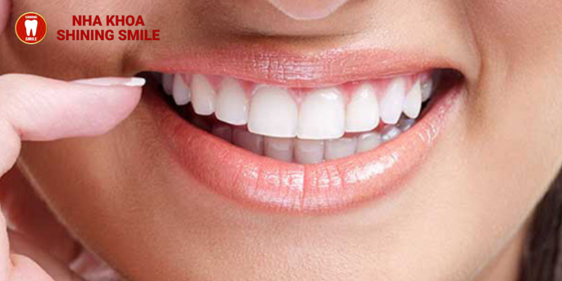 Niềng răng hô nhẹ một cách gọn lẹ từ Shining Smile