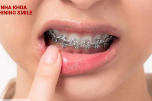 Sắc Màu Tươi Sáng Cho Nụ Cười Hoàn Hảo: Khám Phá Niềng Răng Khấp Khểnh tại SHINING SMILE!