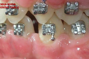 SHINING SMILE - Giải Pháp Sáng Cho Vấn Đề Niềng Răng Hỏng